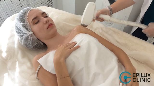 Лазерная эпиляция плеч и предплечья