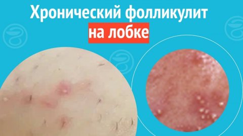 😠 Хронический фолликулит на лобке. Клинический случай №1683