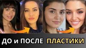 10 ТУРЕЦКИХ АКТРИС КОТОРЫЕ СИЛЬНО ИЗМЕНИЛИСЬ ПОСЛЕ ПЛАСТИКИ