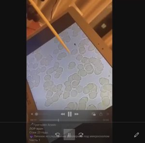 Капля фуллерена изменяет в крови жизнь эритроцитов, паразитов за 10 минут поразительно!  2025-12-07