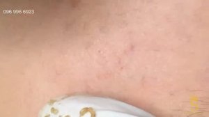 Супер черные точки / Эпичное видео с черными точками (комедонами), завораживающая процедура