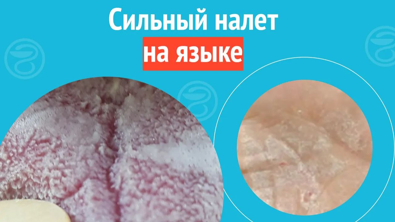 👅 Сильный налет на языке. Клинический случай №1693