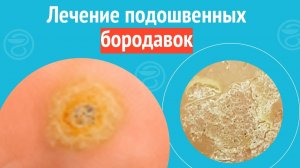 ✅ Лечение подошвенных бородавок. Клинический случай №1697