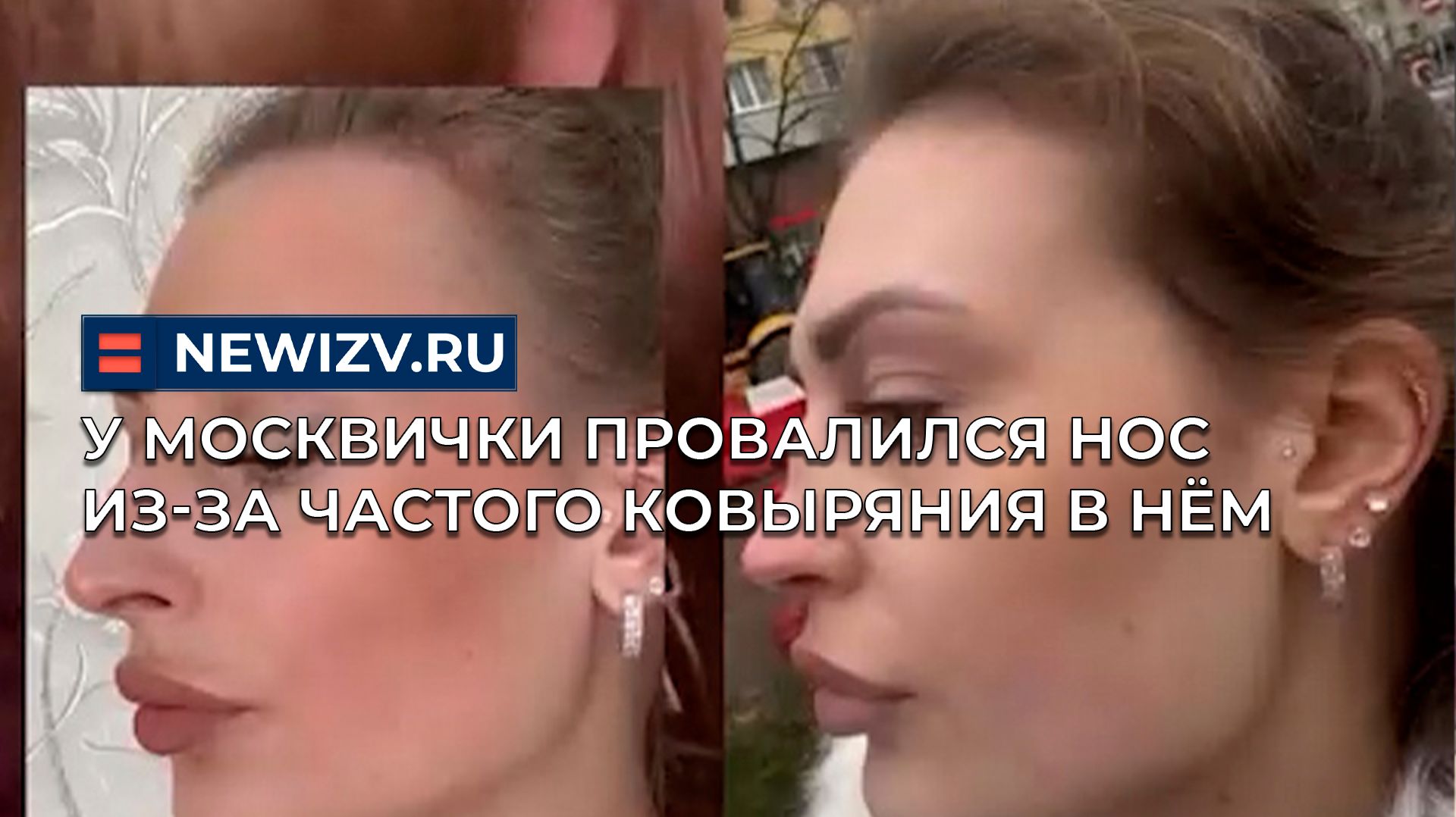 У москвички провалился нос из-за частого ковыряния в нём смотреть онлайн