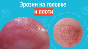 🥺 Эрозии на головке и плоти. Клинический случай №1694