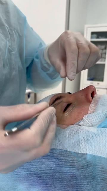 #трансконъюктивальная_блефаропластика: сразу после операции