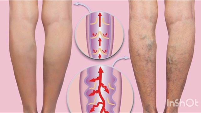 Варикозное расширение вен варикоз