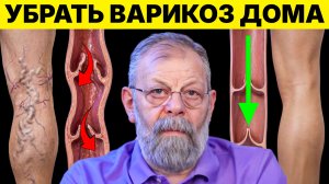 Убрать варикоз дома