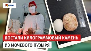 «Весом около килограмма»: врачи извлекли камень из мочевого пузыря жителя Саратовской области
