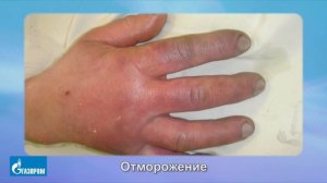 10. Оказание первой помощи при переохлаждении и отморожении