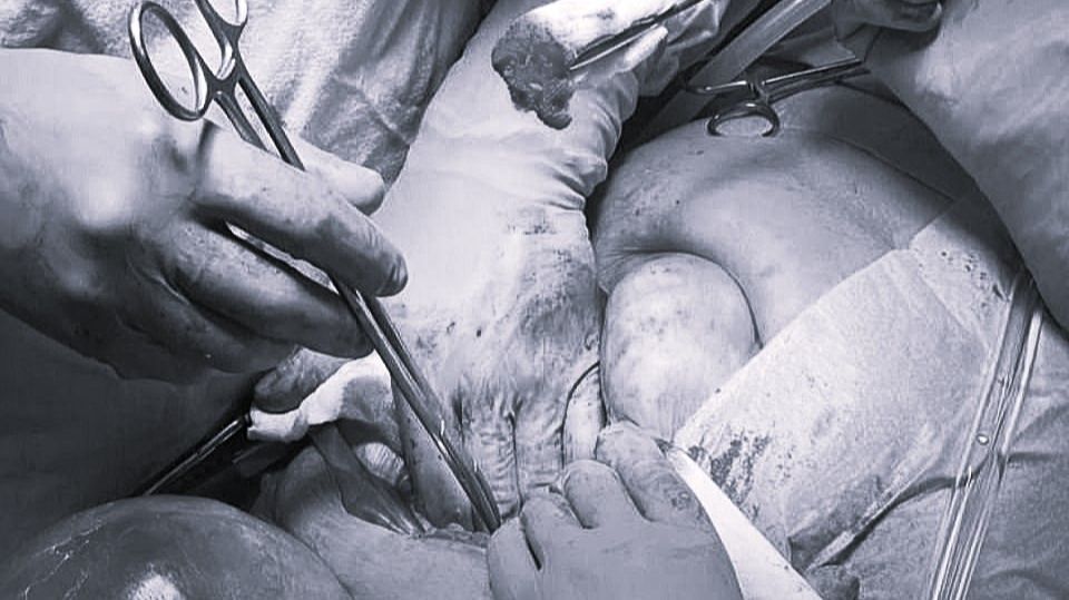 В Сургуте спасли 88-летнюю пациентку с ложной аневризмой