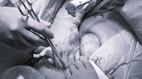 В Сургуте спасли 88-летнюю пациентку с ложной аневризмой