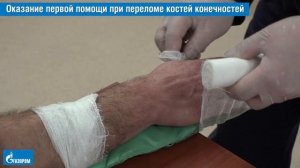 18. Оказание первой помощи при переломе костей конечностей