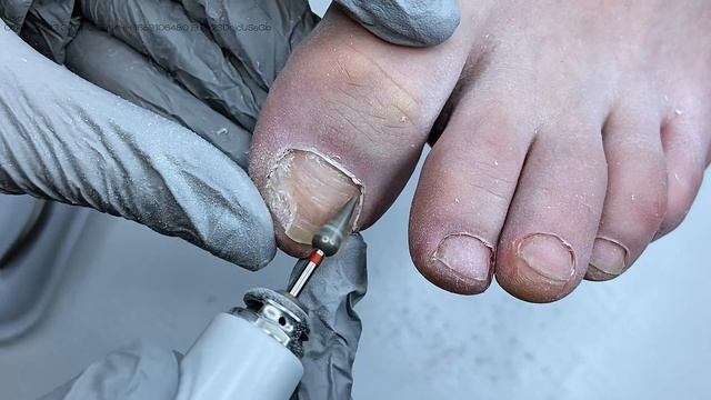 синдактилия + деформация ногтевой пластины из-за тесной обуви + обработка онихолизиса