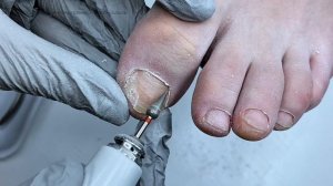 синдактилия + деформация ногтевой пластины из-за тесной обуви + обработка онихолизиса