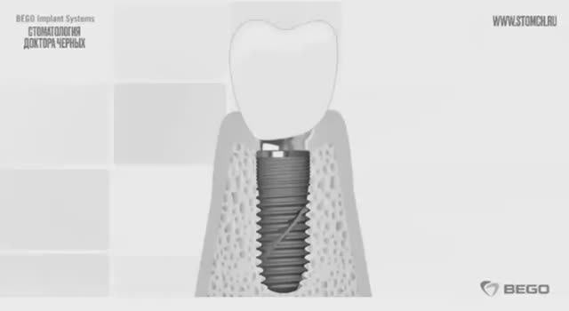 Протезирование зубов на немецких имплантах Bego Semados