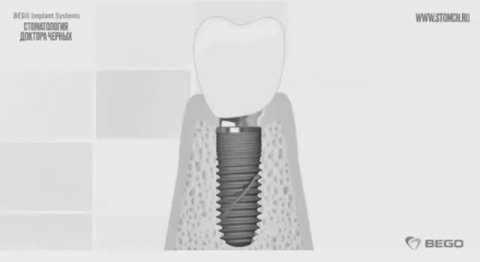 Протезирование зубов на немецких имплантах Bego Semados