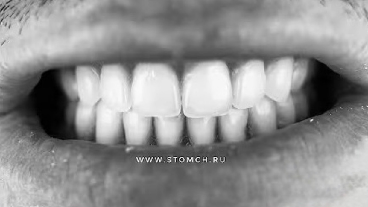 Протезирование полными съемными протезами в Липецке. Врач стоматолог Черных Максим Игоревич.