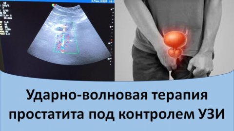 Ударно-волновая терапия простатита под контролем УЗИ