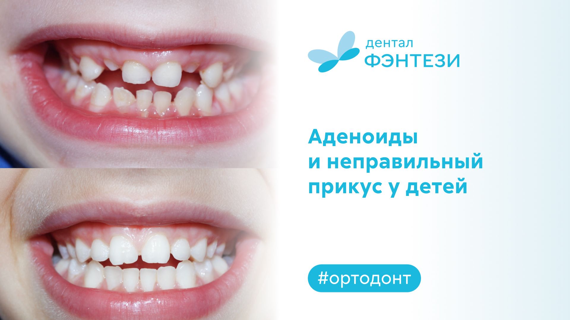 Аденоиды и неправильный прикус у детей