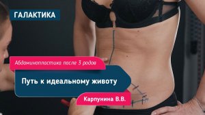 Абдоминопластика после трёх родов — путь к идеальному животу | Варвара Карпунина