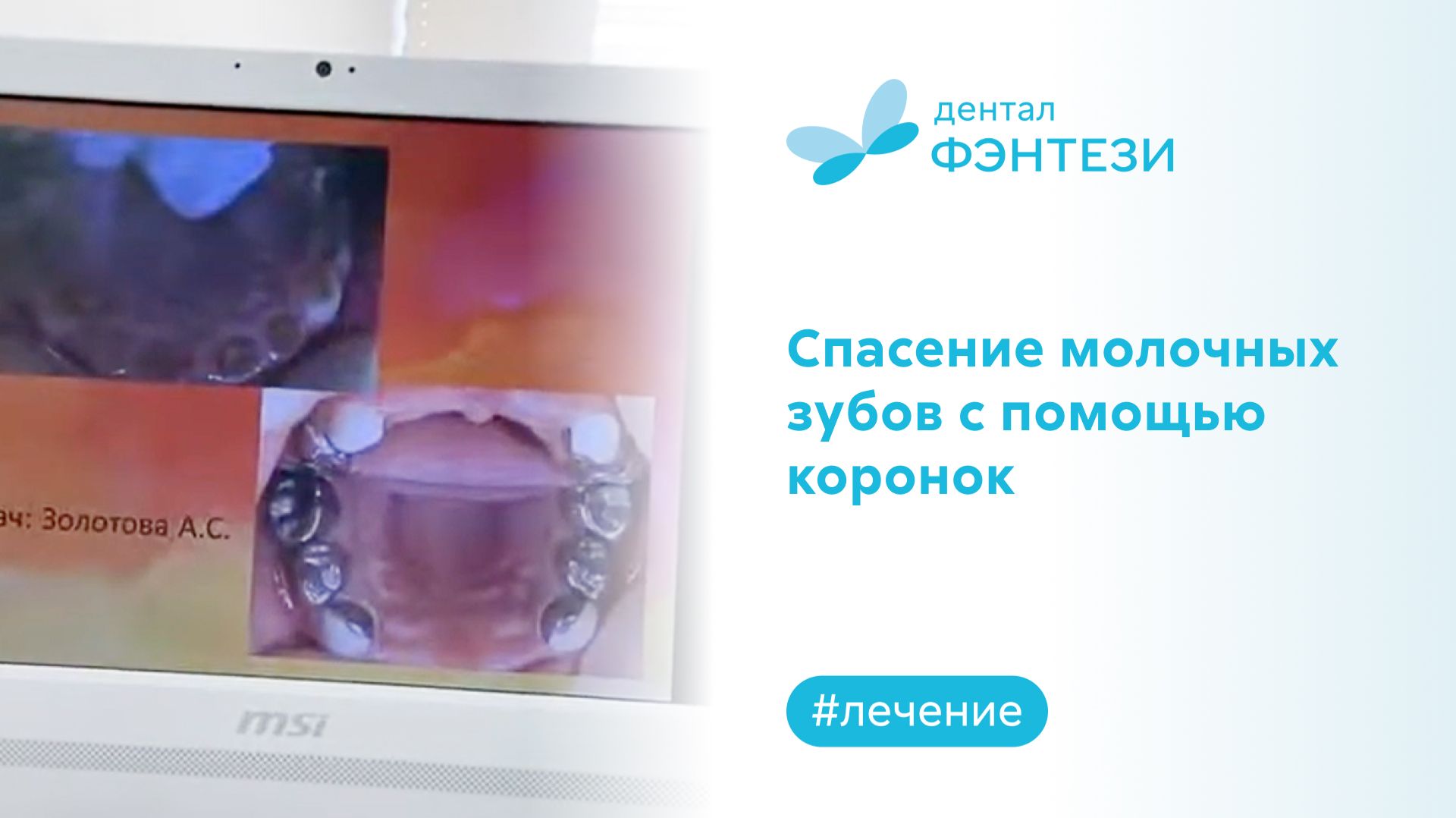 Спасение молочных зубов с помощью коронок