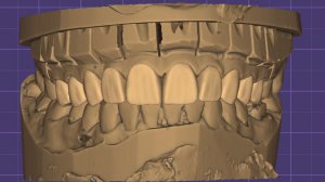 Моделирование виниров + корректировка зенитов