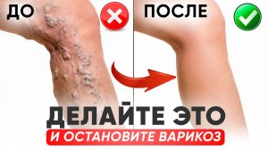 КАК ИЗБЕЖАТЬ ВАРИКОЗА ПОСЛЕ 40: простые упражнения для ног дома