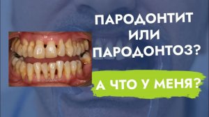 Есть ли разница между пародонтитом и пародонтозом?