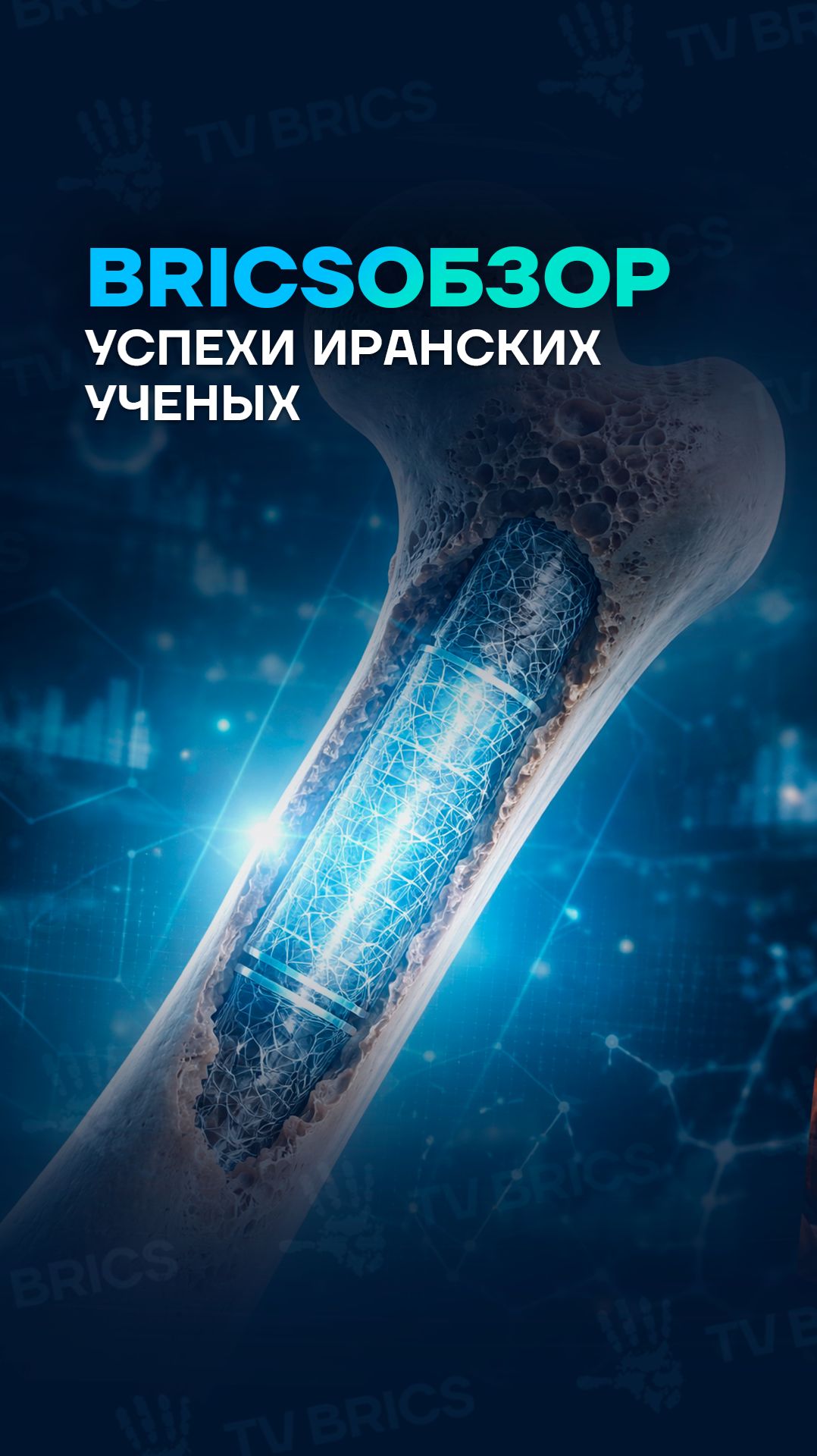 Как восстанавливают кости в Иран с помощью инноваций смотреть онлайн