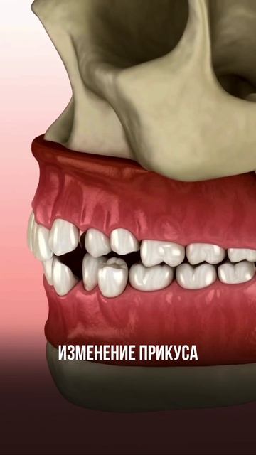 Что будет, если после удаления зуба не восстановить его?