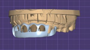 Шаблон для коррекции десны