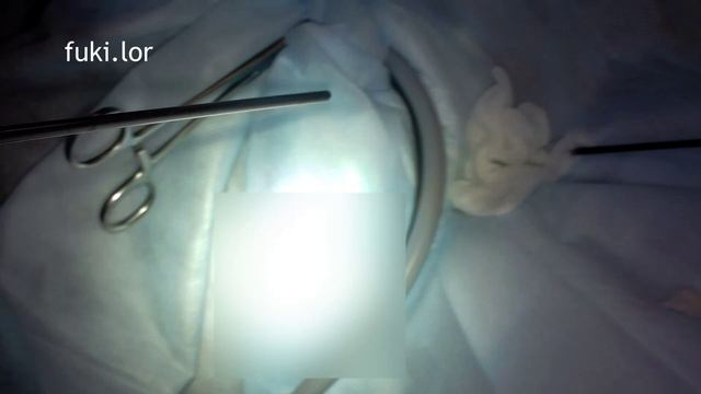 Сосудистый полип перегородки носа смотреть онлайн