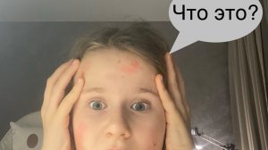 Собираемся в Москву у меня началась аллергия !!!!!