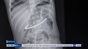 Органы, опоясанные бусами: кемеровские врачи спасли малышку, проглотившую магниты