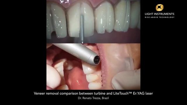 Сравнение снятия виниров с помощью турбины и LiteTouch™ Er YAG лазера
