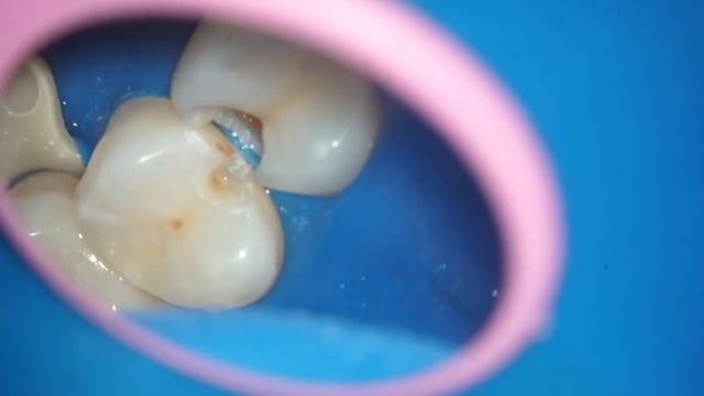 Удаление кариеса Белоус С. Лазер LiteTouch Er:YAG