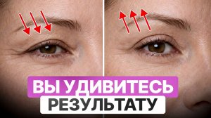 Как убрать нависшее веко, птоз верхнего века и морщины вокруг глаз БЕЗ операции?
