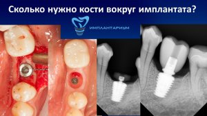 Необходимые биологические условия для долговременного успеха имплантатов (часть 2)