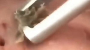 Выдавливание чёрных точек #черныеточки #чисткалица #проблемнаякожа