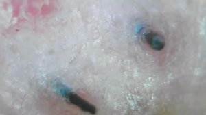 Удаление вросших волос