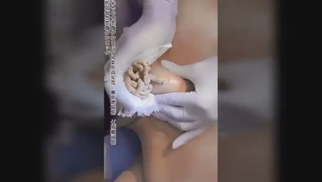 Лучшая подборка видео: Выдавливание прыщей, кист, удаление черных точек и дезинфекция Ч 16