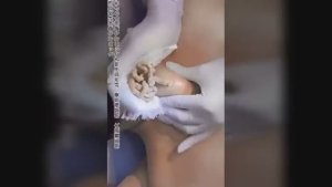 Лучшая подборка видео: Выдавливание прыщей, кист, удаление черных точек и дезинфекция Ч 16