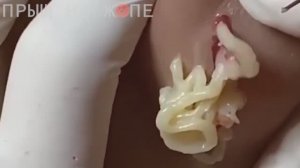 ПРЫЩ НА ЖОПЕ!!! #механическаячистка #удалениепрыщей #акне