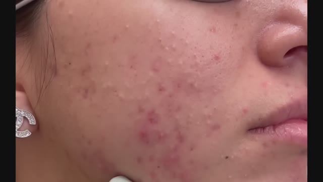 Ваши любимые удаления #5. Черные точки, белые угри, чистка ушей, выдавливание прыщей.