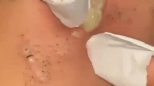 Прыщи _ Огромные прыщи _ Релакс с акне _ Выдавливание прыщей _ Черная точка #Прыщ