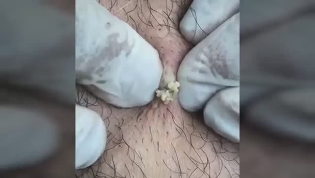 Лучшая подборка видео: Выдавливание прыщей, кист, удаление черных точек и дезинфекция Ч 14