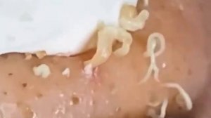 Прыщи _ Огромные прыщи _ Релакс с акне _ Выдавливание прыщей _ Черная точка #Прыщи_1