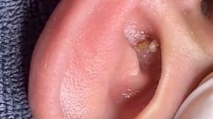 Прыщи _ Огромные прыщи _ Релакс с акне _ Выдавливание прыщей _ Черная точка #Прыщи