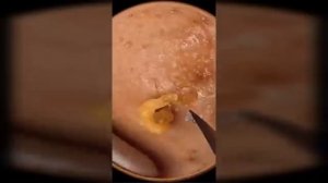 Лучшая подборка видео: Выдавливание прыщей, кист, удаление черных точек и дезинфекция Ч 13
